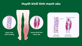 Điều trị suy giãn tĩnh mạch và những biến chứng tiềm ẩn cần biết